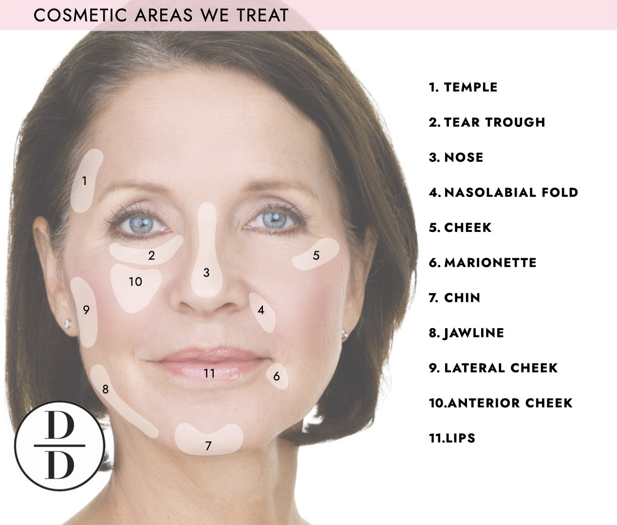 Dermal filler treatment areas