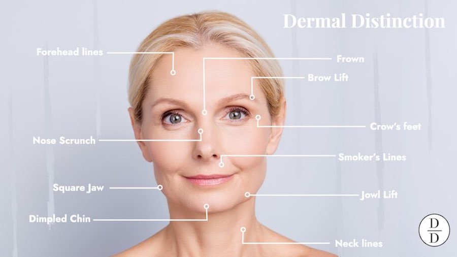 antiwrinkle injections in balwyn